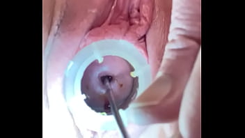 Dilatación profunda del orificio cervical con sonido doloroso