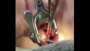 Tenir le col de l'utérus avec le tenaculum pendant que le dilatateur mm baise l'utérus